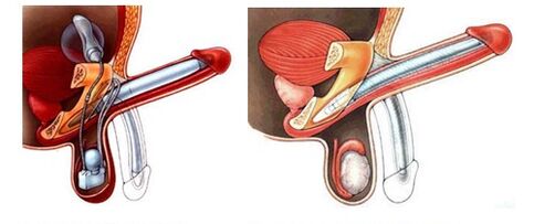 Penis with an inflatable prosthesis (left) and plastic (right)