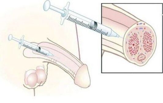 The joy of hyaluronic acid injection