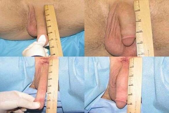 Measure the penis after enlargement surgery